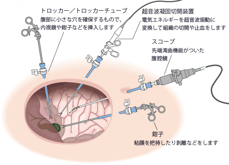 腹腔鏡手術のイメージイラスト